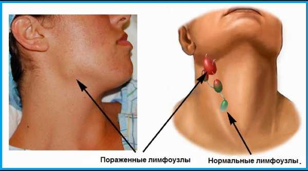 Симптоми та ознаки раку лімфовузлів на шиї