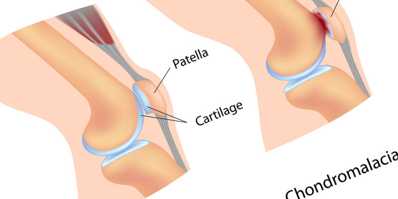 Синовіт колінного суглоба лікування народними засобами