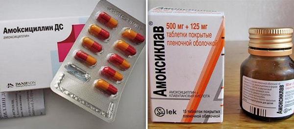 Синусит як лікувати в домашніх умовах. Чи можливо вилікувати синусит народними засобами