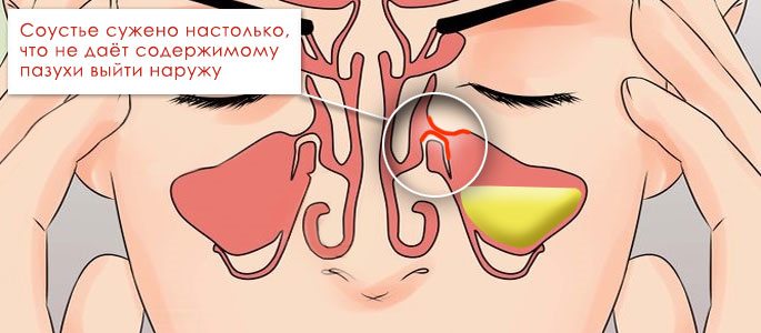 Синусит як лікувати: вибираємо ефективний засіб