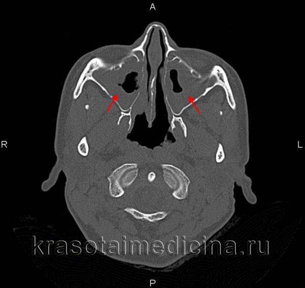 Синусит – запалення носових пазух. Причини, симптоми, методи діагностики і лікування синуситу