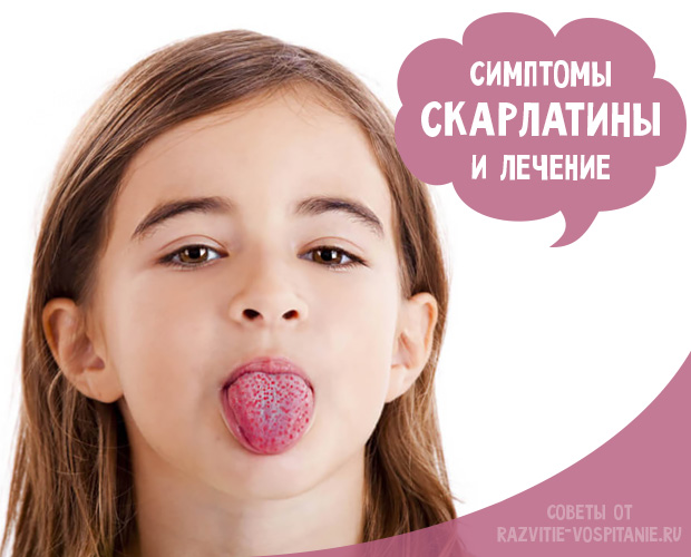 Скарлатина у дітей механізм зараження лікування та профілактика захворювання