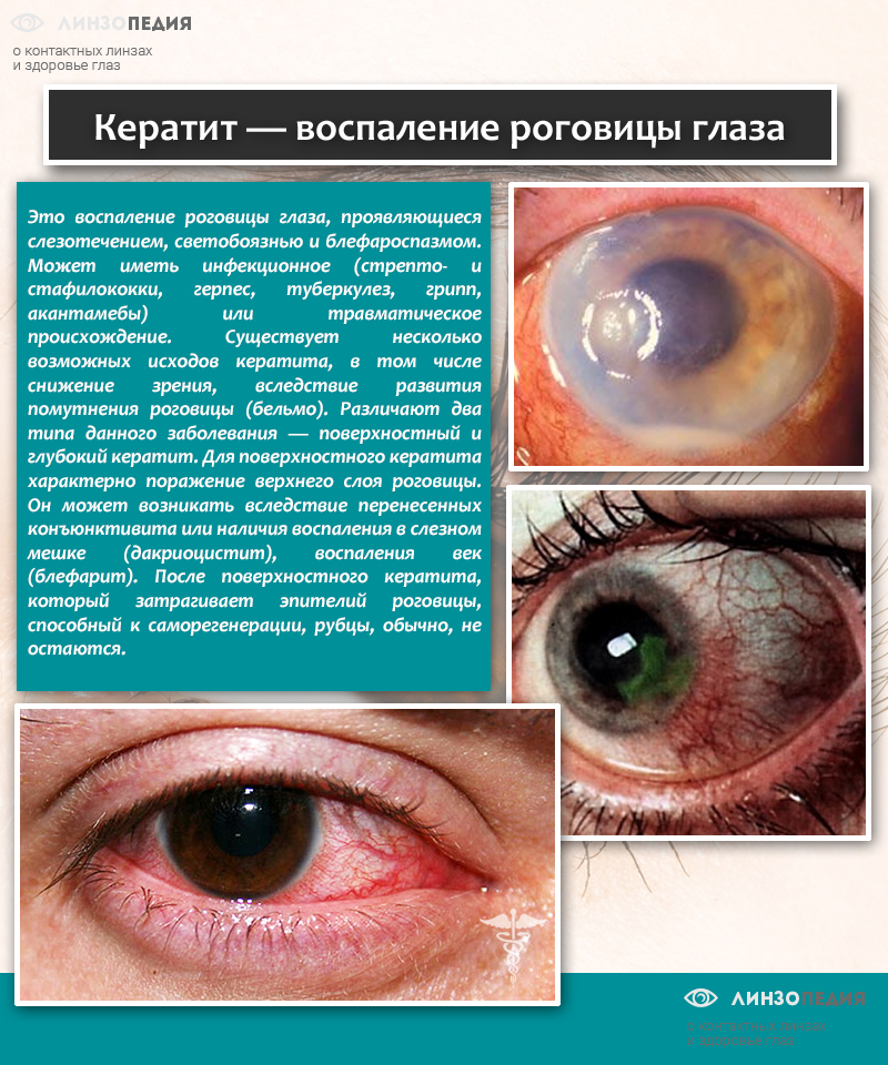 Сльозоточивість очей – причини і лікування. Як і чим вилікувати в домашніх умовах