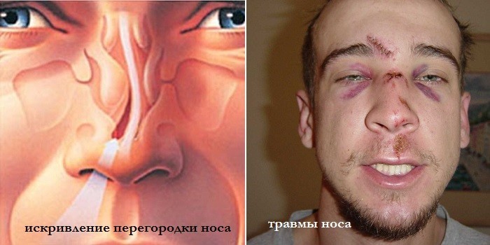 Соплі при гаймориті їх колір і як правильно сякатися