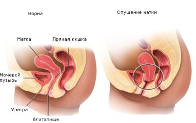 Специфіка лікування частого сечовипускання у жінок