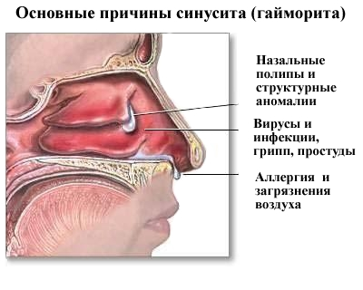 Стадії гаймориту: лікування на початковій стадії хвороби