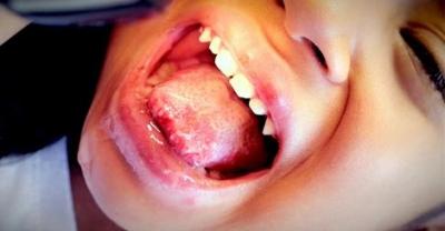 Стоматит і ангіна причини одночасного розвитку симптоми і лікування Стоматит і ангіна причини одночасного розвитку симптоми і лікування