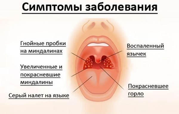 Стрептоцид при ангіні