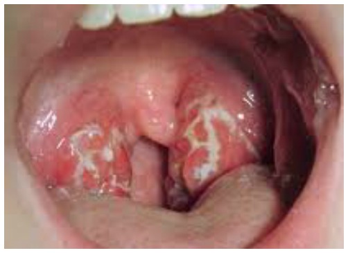 Стрептокок в горлі основні симптоми і способи лікування інфекції