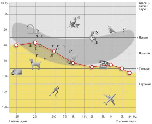 Ступеня (стадії) приглухуватості — Нейросенсорна приглухуватість