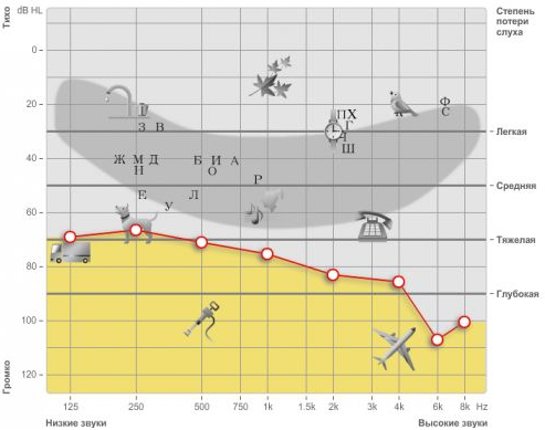 Ступеня (стадії) приглухуватості — Нейросенсорна приглухуватість