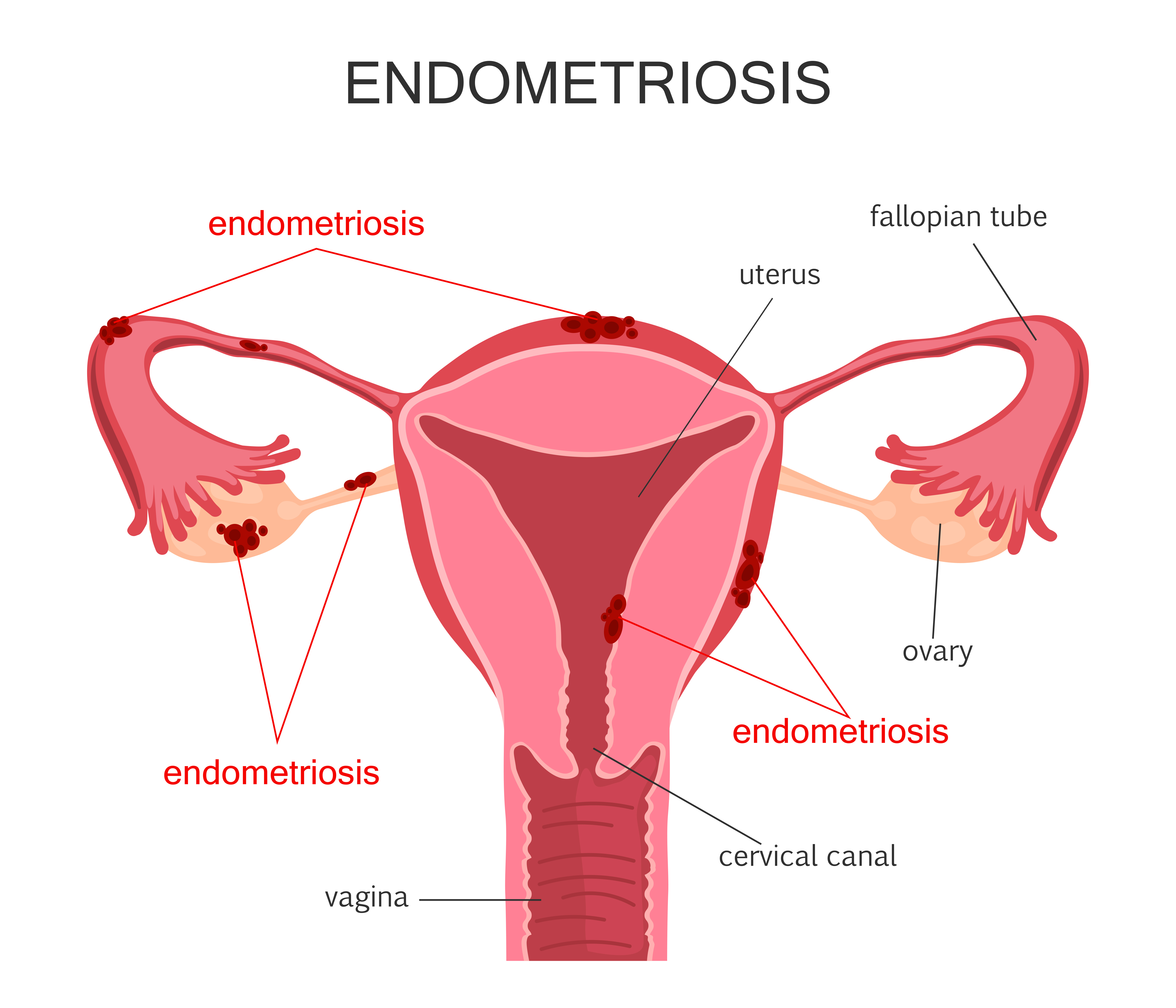 Сучасні методи лікування ендометріозу – Медицина і здоров’я