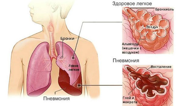 Сухий кашель та біль у грудній клітці: причини виникнення, лікування. Грудної кашель у дорослих без температури — як лікувати недугу?