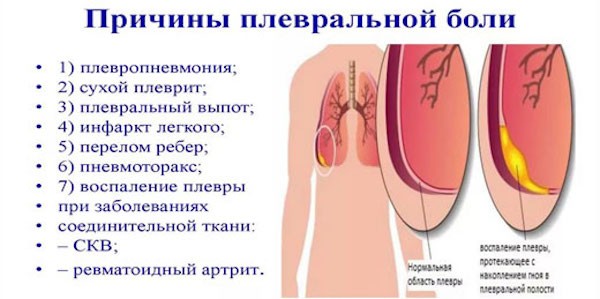 Сухий плеврит легенів – причини і лікування хвороби