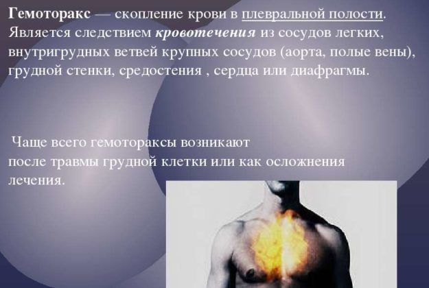 Сухий плеврит легенів – причини і лікування хвороби