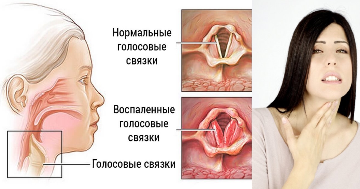 Свербить всередині горла як лікувати