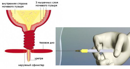 Таблетки при нетриманні сечі у жінок: особливості лікування