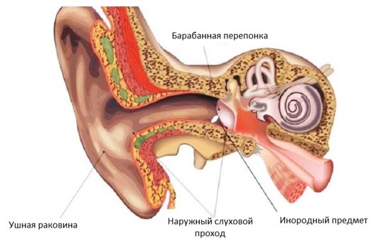 Техніка видалення стороннього тіла з вуха. Сторонні тіла вуха