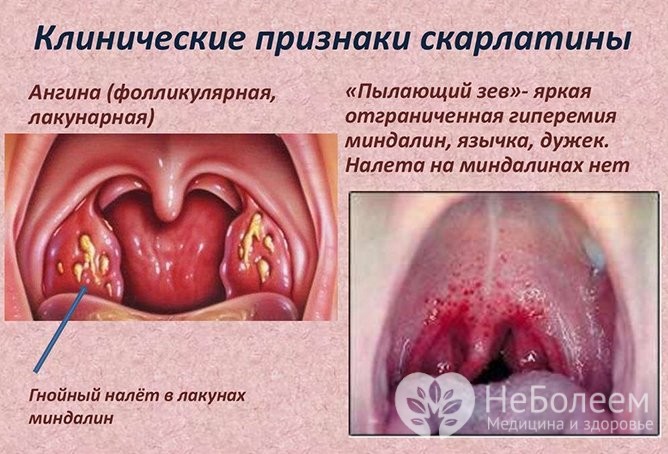 Тонзиліт основні ознаки та форми хвороби