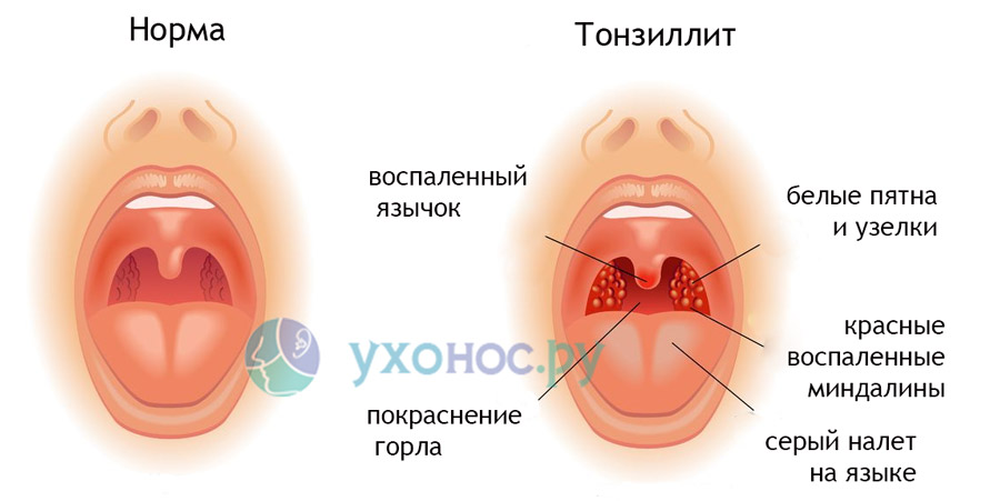 Тонзиліт основні ознаки та форми хвороби