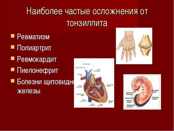 Тонзиліт – симптоми і лікування у дорослих хронічного, причини і ознаки