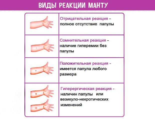 Треба дитині робити Манту і що буде при відмові від проби