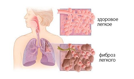 Тривалість життя при фіброзі легень