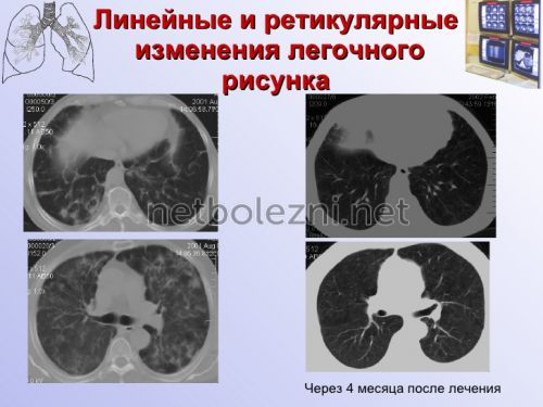 Тривалість життя при фіброзі легень