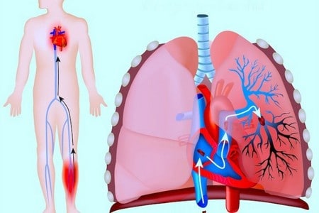 Тромбоемболія гілок гілок легеневої артерії