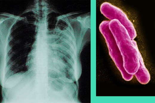 Туберкульоз легенів – перші симптоми, опис ознак ранній стадії захворювання у дорослих і дітей, лікування