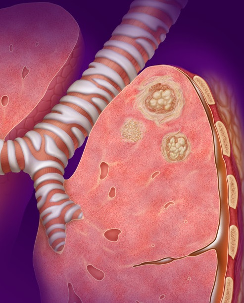 Туберкульоз легенів – перші симптоми, опис ознак ранній стадії захворювання у дорослих і дітей, лікування