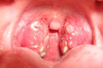 У чому причина білого нальоту в горлі у дитини
