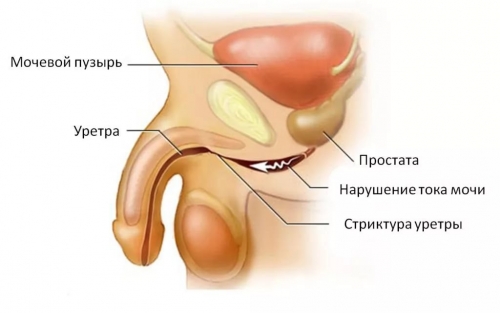 Уретрит у чоловіків симптоми лікування препарати причини