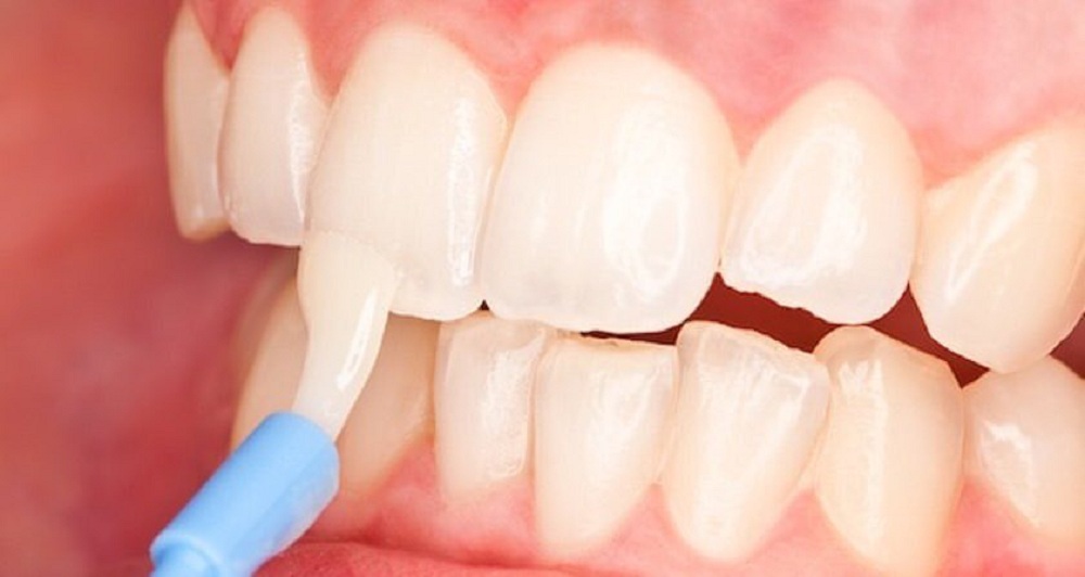 Відновлення емалі зубів в домашніх умовах