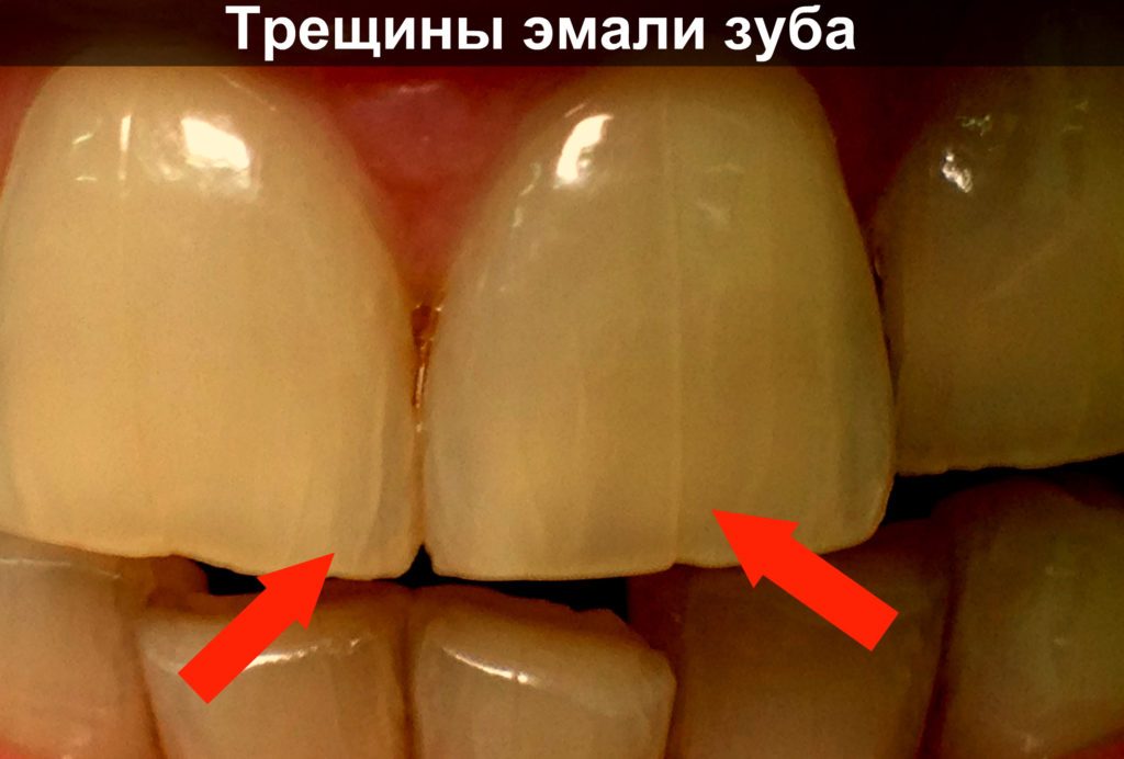 Відновлення емалі зубів в домашніх умовах