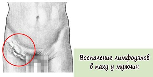В області паху почали з’являтися поколювання