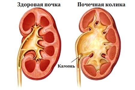 В області паху почали з’являтися поколювання