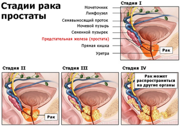 В яких випадках можливий позитивний прогноз при раку простати В яких випадках можливий позитивний прогноз при раку простати