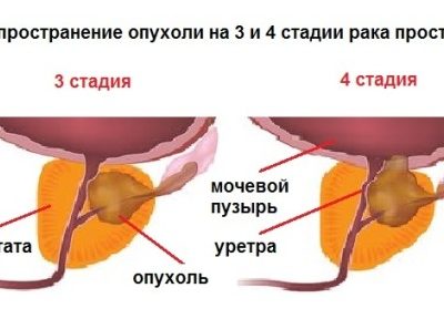 В яких випадках можливий позитивний прогноз при раку простати В яких випадках можливий позитивний прогноз при раку простати