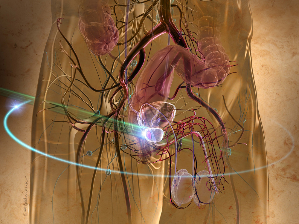 В яких випадках можливий позитивний прогноз при раку простати В яких випадках можливий позитивний прогноз при раку простати