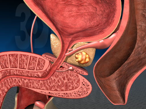 В яких випадках можливий позитивний прогноз при раку простати В яких випадках можливий позитивний прогноз при раку простати