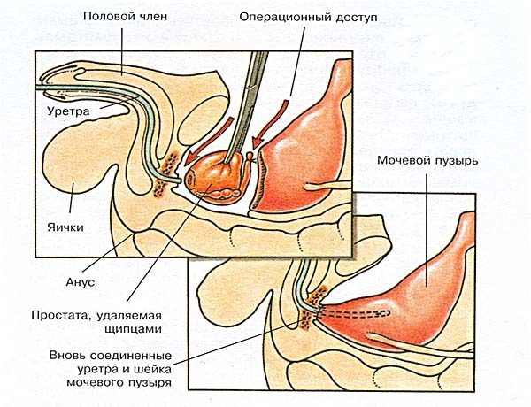 В яких випадках можливий позитивний прогноз при раку простати В яких випадках можливий позитивний прогноз при раку простати