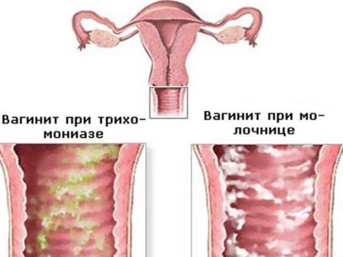 Вагініт у жінок: симптоми і лікування