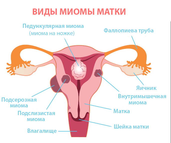 Виділення при міомі матки які бувають причини появи
