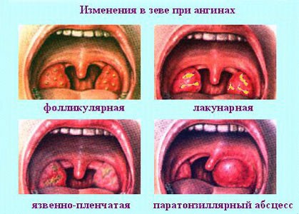 Види ангін – які бувають різновиди захворювання