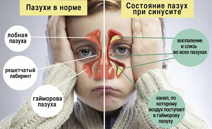 Види краплі від гаймориту вибираємо найкраще і зручний засіб