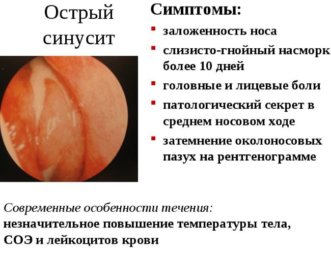 Види пансинусита гострий хронічний поліпозний гнійний їх симптоми і лікування