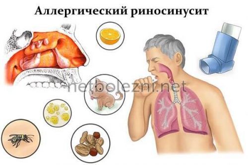 Види риносинуситу симптоми і лікування у дорослих