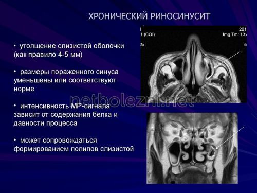 Види риносинуситу симптоми і лікування у дорослих