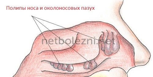 Види риносинуситу симптоми і лікування у дорослих